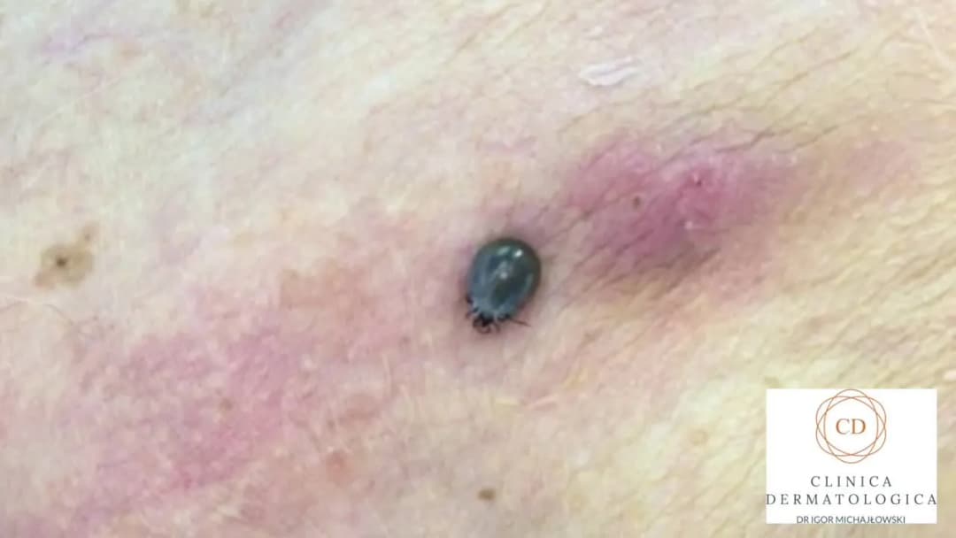 Opity kleszcz po 24h: Jak wygląda, co oznacza i jak go usunąć?