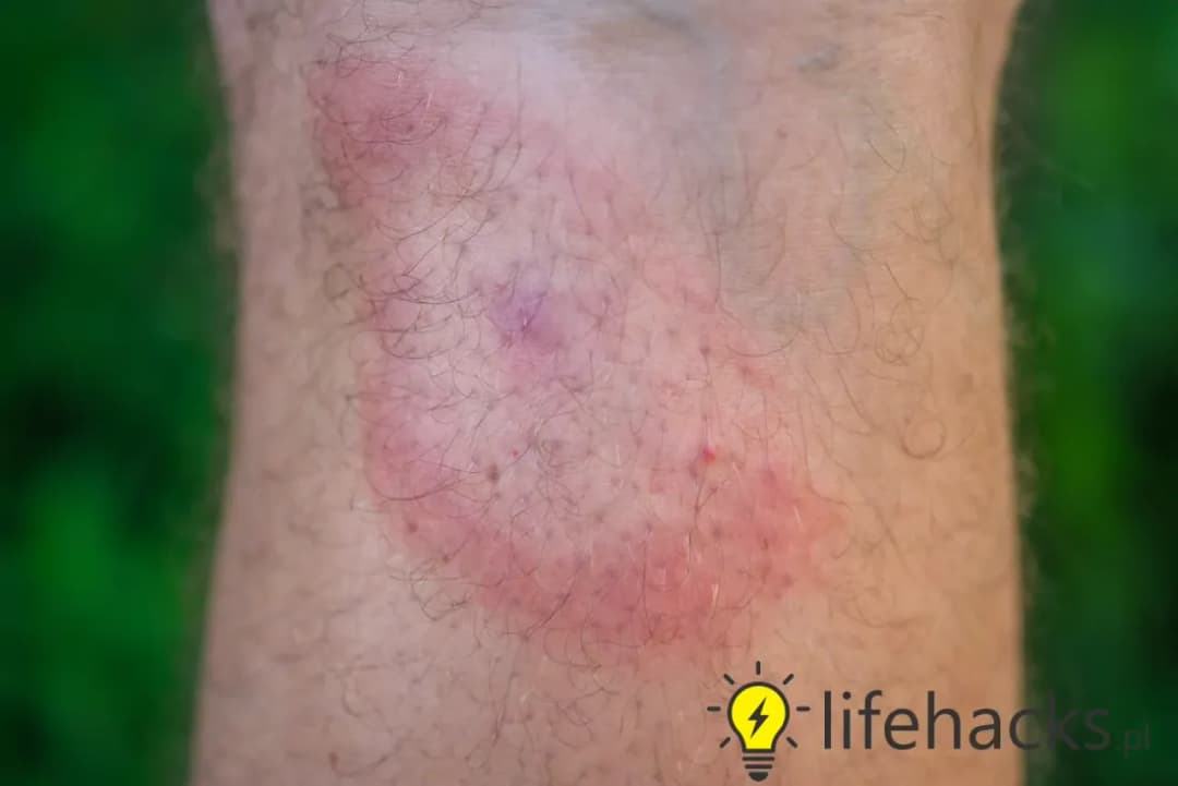 Kleszcze pod skórą? Fakty, usuwanie i objawy chorób