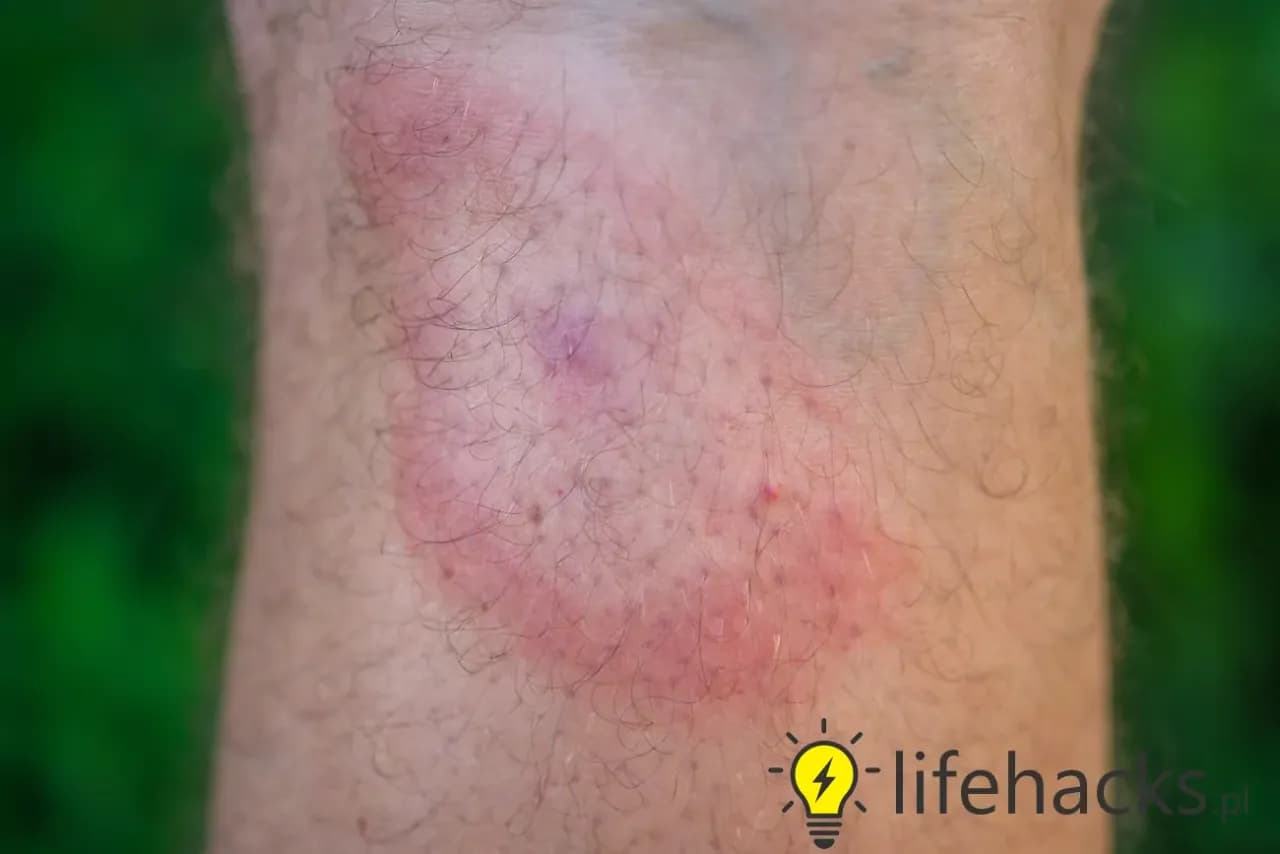 Kleszcze pod skórą? Fakty, usuwanie i objawy chorób