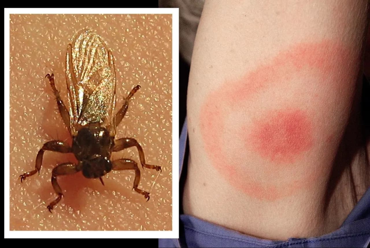 Latający kleszcz: objawy ukąszenia, czy grozi boreliozą?