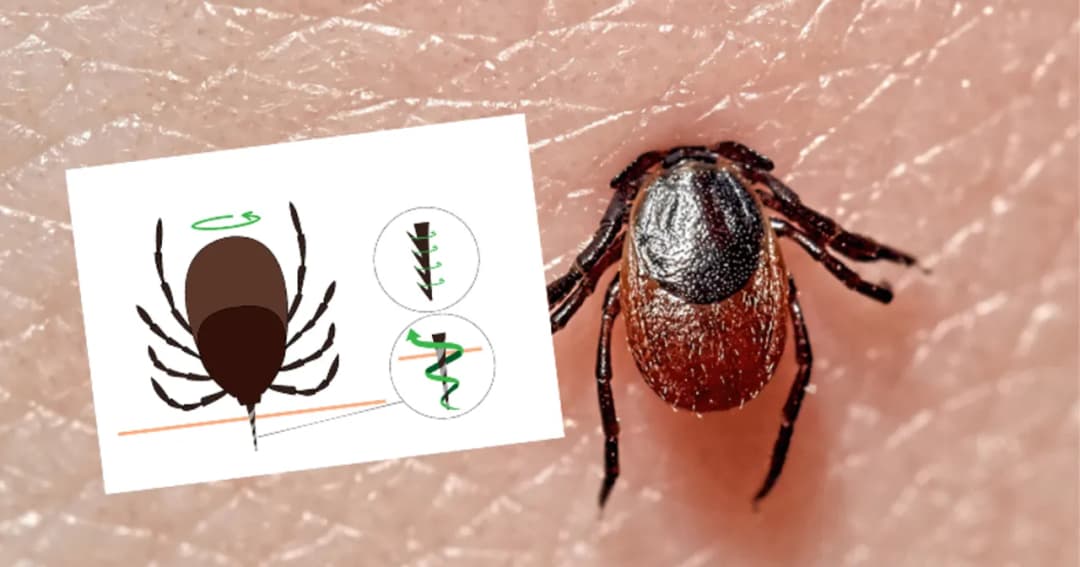 Co jeśli zostanie fragment kleszcza? Sprawdź, co robić!